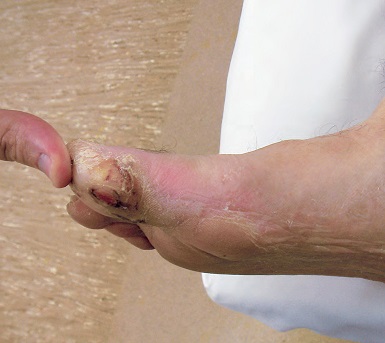 Takojšnja prepoznava diabetičnega stopala lahko reši ud
